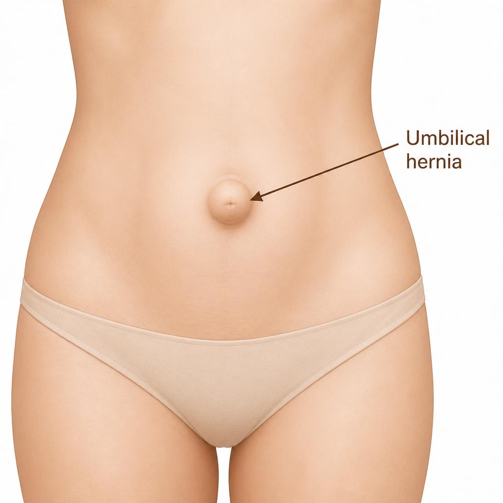 Entenda a hérnia umbilical